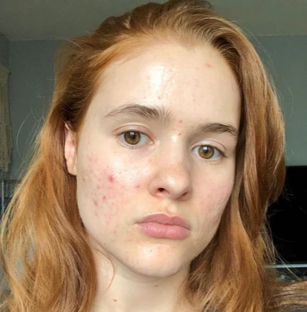 Skin Enhancer — before